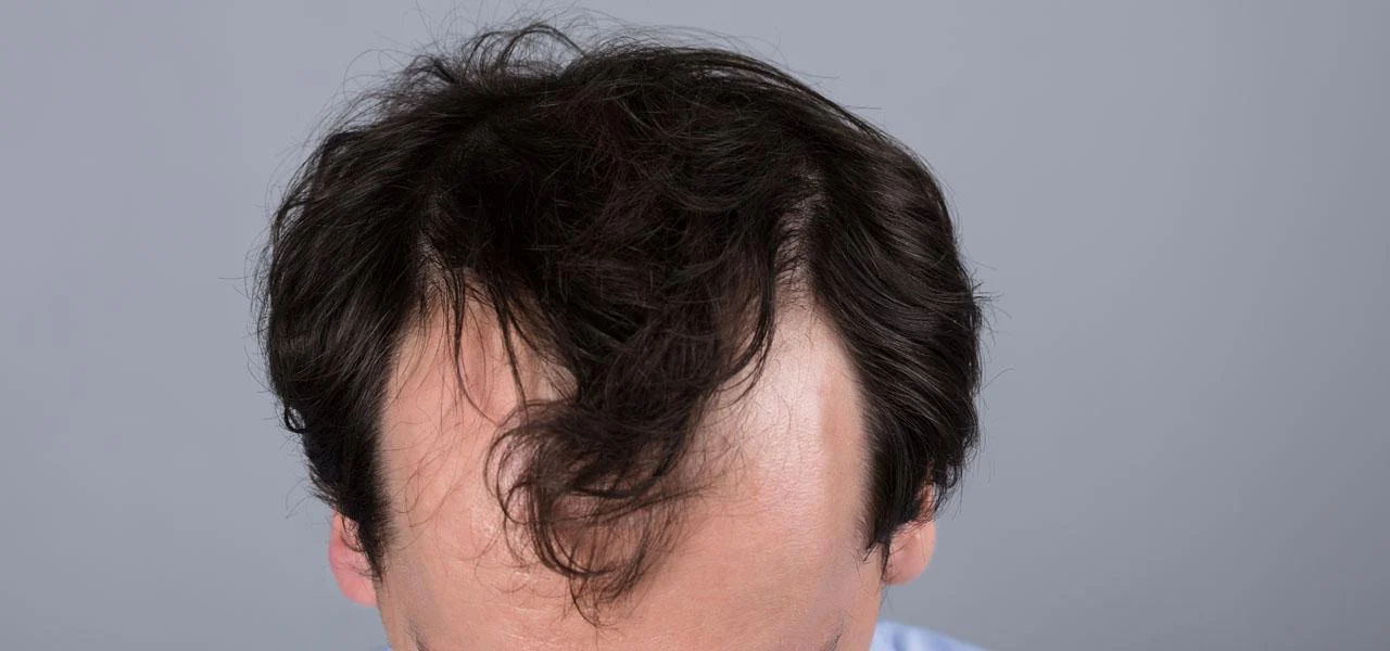 Male pattern hair loss