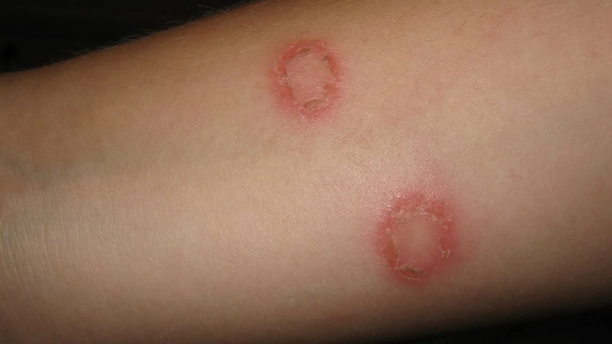 Allergic Reactions and Skin Rash - Aesthetic & Dermatology Center